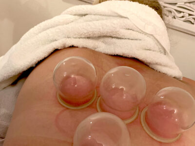 Cupping
